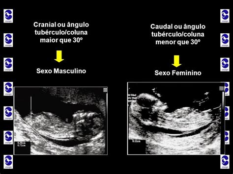 Gravidez Quando Vou Descobrir O Sexo Do Bebê Da Fertilidade à Maternidade