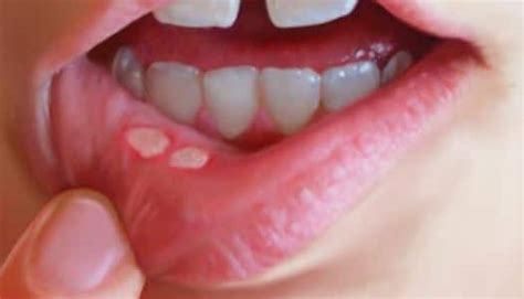 Pimpleon Inside Of Mouth How To Get Rid Of It