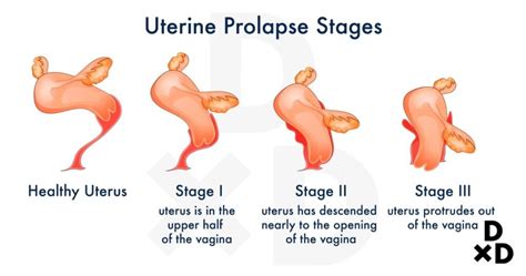 Uterine Prolapse Results In Signs And Symptoms And Procedure
