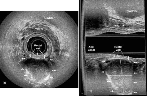 Endoanal Imaging Of Anorectal Cysts And Masses Abdominal Key