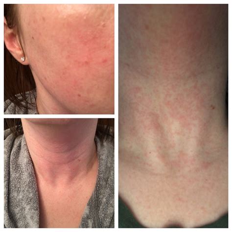 Skin Concerns Itchy Hive Y Rash On Mostly Neck Some Face Reaction