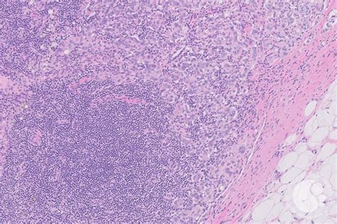 Lymph Node With Metastatic Breast Carcinoma