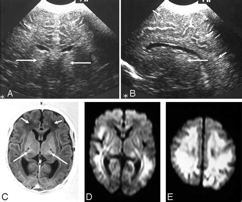 Cranial Ultrasound In Metabolic Disorders Presenting In The Neonatal