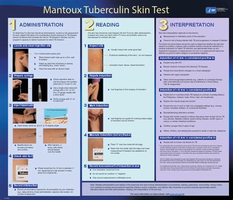 Mantoux Tuberculin Skin Test Administration Reading And