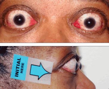 Thyroid Eye Disease Symptoms TEPEZZA Teprotumumab Trbw