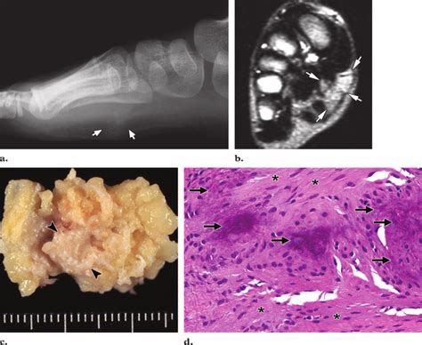 Calcifying Aponeurotic Fibroma In A 1 Year Old Child With A Slowly