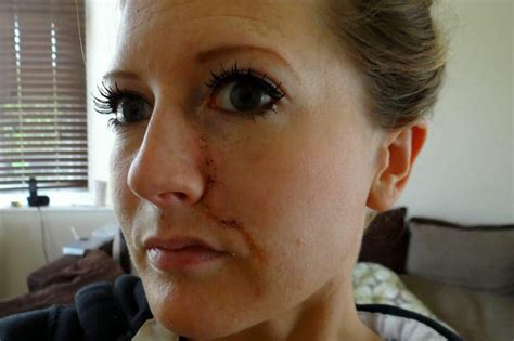 Skin Cancer Victim Has Chunk Of Face Cut Out After 900 Hours On Sunbeds