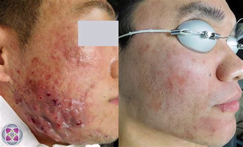 Laser Acne Treatment To Eliminate Cystic Acne
