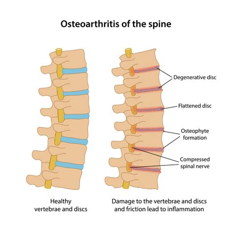 Before we take a look at what causes middle back pain, let's do a quick recap on what the middle back is comprised of Your Guide to Mid Back Pain Causes. What and where do they ...