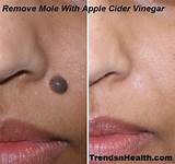 Laser Treatment To Remove Scars On Face