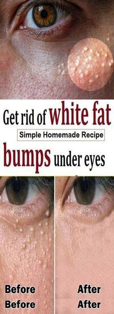 The Small White Bumps On Your Skin Which Generally Appear Around Your
