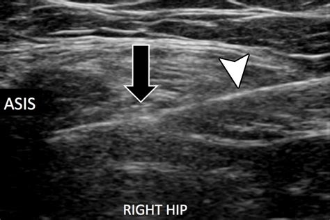 Us Guided Musculoskeletal Interventions In The Hip With Mri And Us