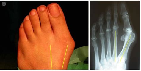 Bunion Hallux Valgus What Is It Symptoms And Treatment Top Doctors