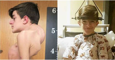 Teenager With Severe Scoliosis Is Transformed After Surgery