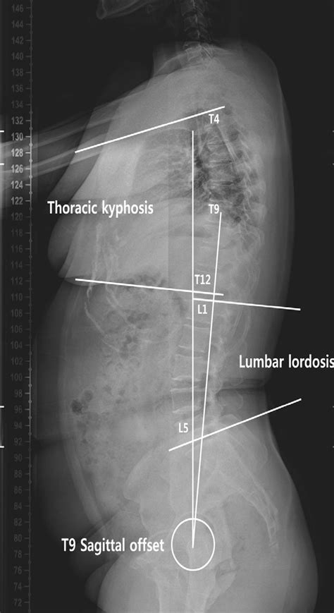 method of measurement of spinal parameters on radiography pelvic download scientific diagram