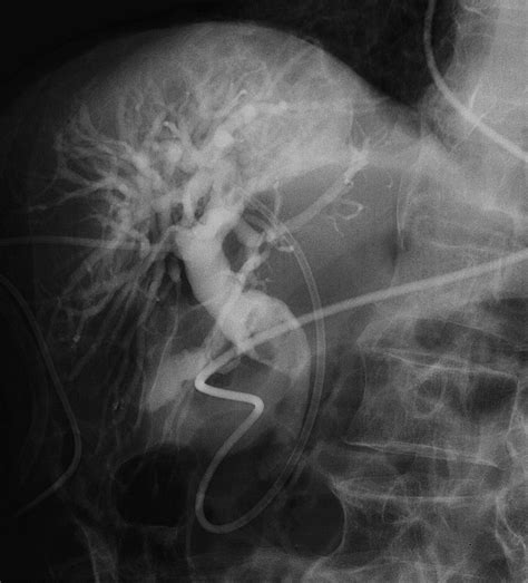 A Rare Complication During Ercp And Sphincterotomy Placement Of An