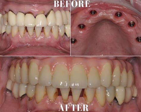 Maxillary Implant Reconstruction Dr Goetz Prosthodontics