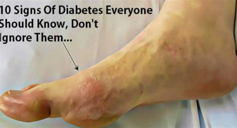 10 Signs Of Diabetes Everyone Should Know Dont Ignore Them Healthy