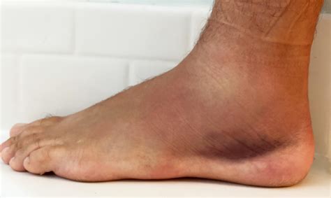What I Learned Treating My Own Ankle Sprain Kembeo