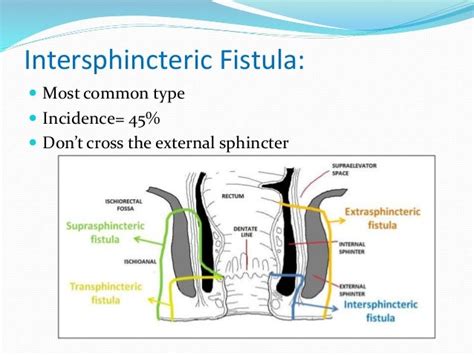 Anal Fistula And Anal Fissure