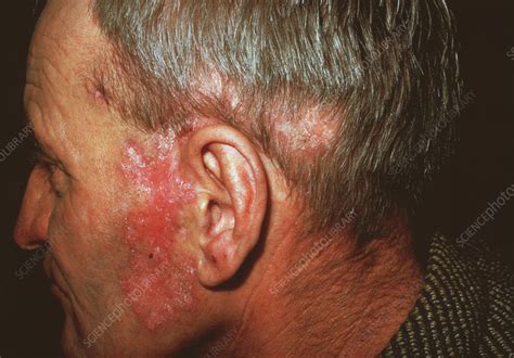 Lupus Skin Rash Stock Image M2000172 Science Photo Library