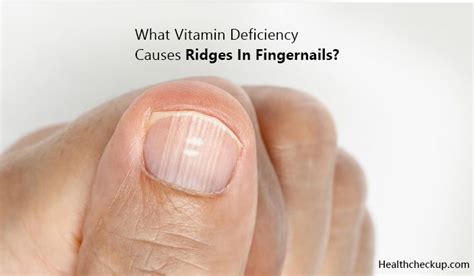 What Vitamin Deficiency Causes Vertical Lines In Toenails Design Talk