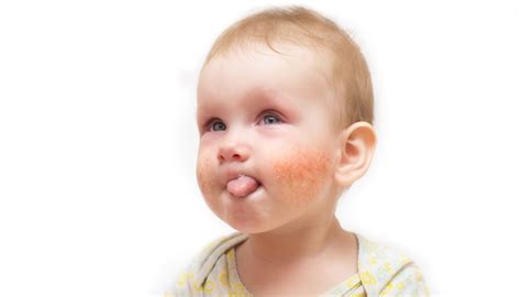 Treating Teething Rash Advice From Experts