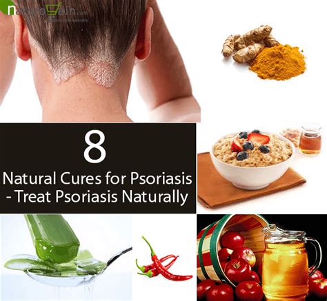 8 Powerful Natural Cures For Psoriasis Treat Psoriasis Naturally