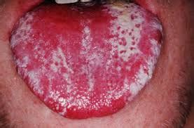 Your mouth is red inside and you have white patches. Oral Thrush | Muswell Hill Smile