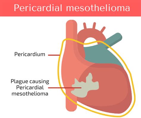 Oct 20, 2020 · pericardial mesothelioma, which affects tissue that surrounds the heart, can cause signs and symptoms such as breathing difficulty and chest pains. Symptoms of mesothelioma lung cancer - Healthveins