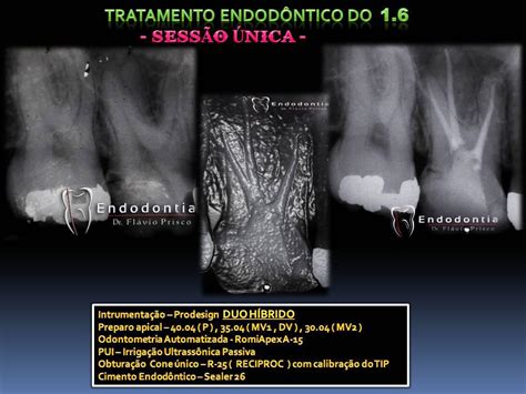 Descobrindo E Explorando A Endodontia Tratamento Endodontico Do