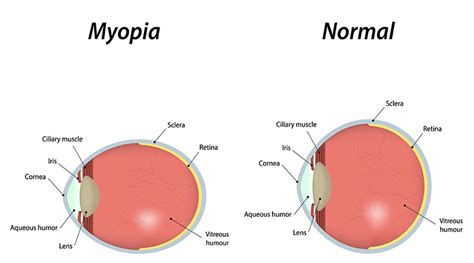 Nearsightedness Myopia Dr Francis Dubé Optometry