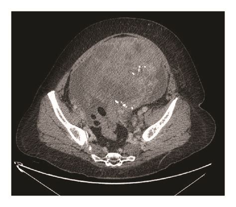 Ct Scan Of The Abdomen Showing A Large Heterogeneous Partially