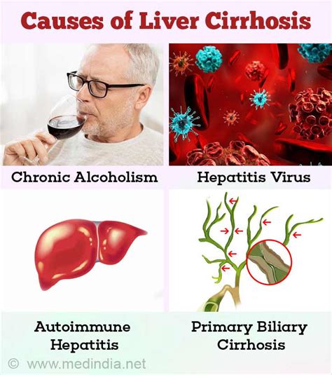 Liver Cirrhosis Causes Symptoms Diagnosis Treatment And Prevention