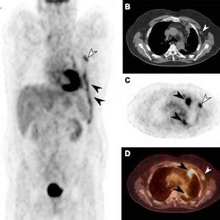 What kind of imaging is used to diagnose mesothelioma? Primary mesothelioma and extrathoracic metastasis on 18 F ...
