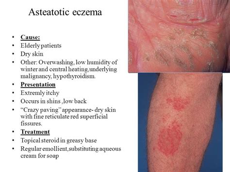 Pin By Harryygr On Dermatology Eczema Causes Emollient Dermatology