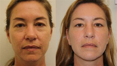 Wrinkle Reduction Лицо Разное