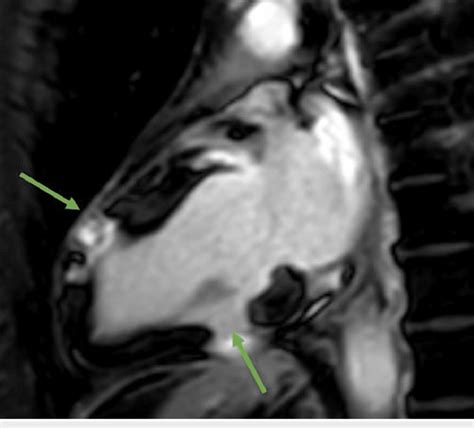 Phase Sensitive Inversion Recovery Sequence Two Chamber View Showing