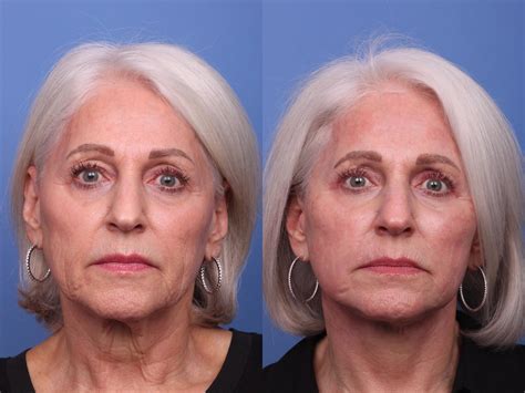 Facelift Before And After Pictures Case 447 Scottsdale Az Hobgood Facial Plastic Surgery