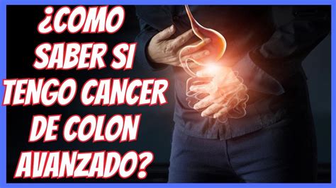 🆘 ¿como Saber Si Tengo Cancer De Colon 🆘 SÍntomas Iniciales En Hombres Y Mujeres Youtube
