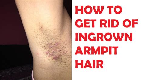 How To Get Rid Of Ingrown Armpit Hair Permanently At Home Youtube