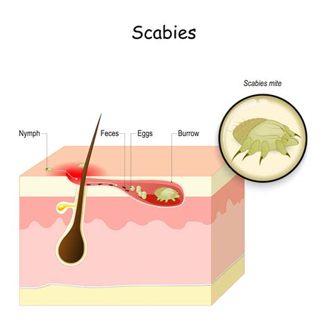 Scabies Causes Rash Signs Treatment Options