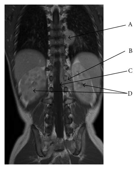 Mri Coronal T1 Gadolinium Left Dorsal Paravertebral Tumor T7t9