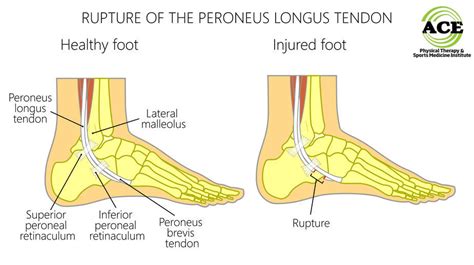 Peroneal Tendon Injuries Falls Church Ankle Instability Fairfax