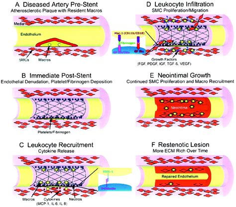 Molecular Basis Of Restenosis And Drug Eluting Stents Circulation