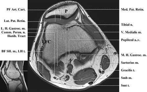 Supplemental Materials For Normal Mr Imaging Anatomy Of The Knee