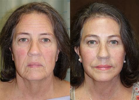 Neck Lifts Without Surgery Fort Worth Plastic Surgery And Med Spa