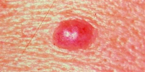 Must Watch Skin Cancer Photos To Identify It