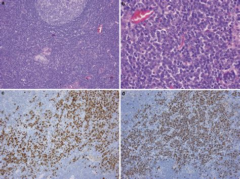 Histopathology Of Systemic Igg4 Related Lymphadenopathy Download