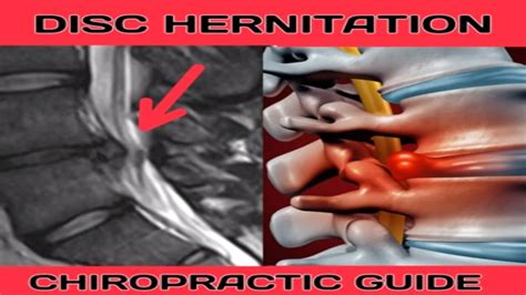 disc herniation a chiropractic guide dublin city chiropractic youtube